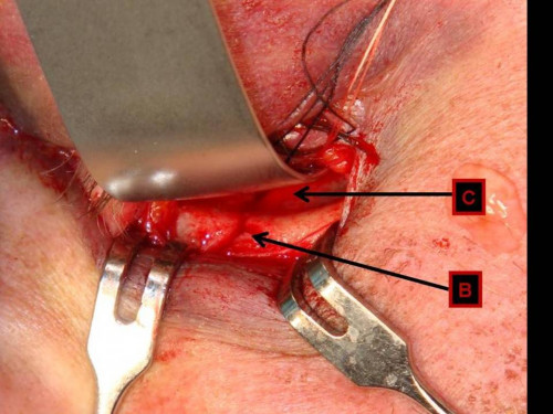 Makroskopie - infraorbital intraoperativ nummeriert