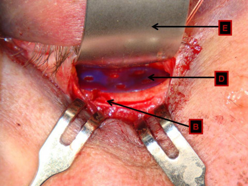 Makroskopie - infraorbital intraoperativ nummeriert
