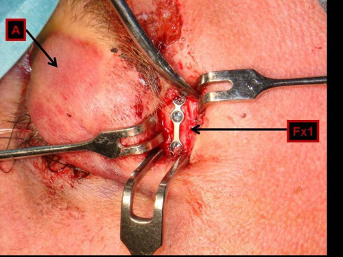 Makroskopie - Sutur intraoperativ nummeriert