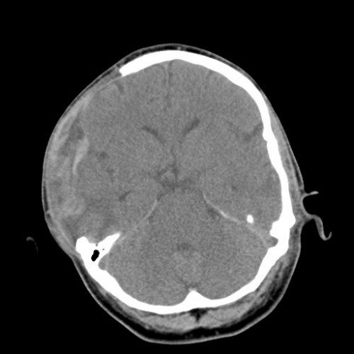 Bildgebung - cCT 4h postoperativ