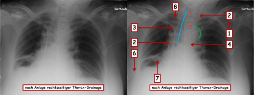 Bildgebung - Röntgen-Thorax nach Thorax-Drainagen-Anlage