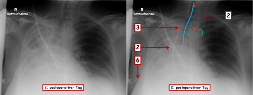 Bildgebung - Röntgen-Thorax 2. postoperativer Tag