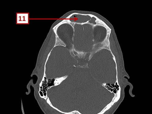 Bildgebung - CT