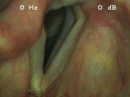 Makroskopie - Lupenlaryngoskopie (90° Optik) Respiration