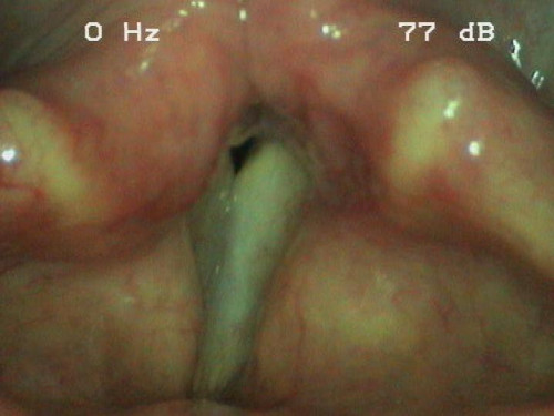 Makroskopie - Lupenlaryngoskopie (90° Optik) Phonation