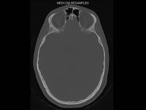 Bildgebung - CT axial
