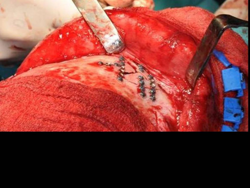 Makroskopie - intraoperativ