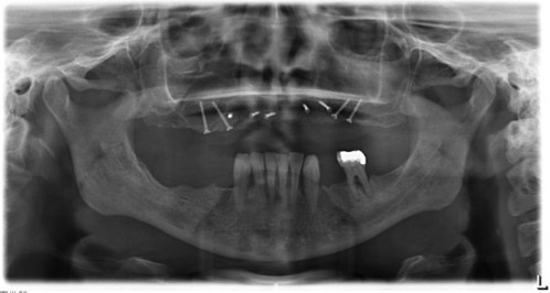 Bildgebung - OPAN postoperativ