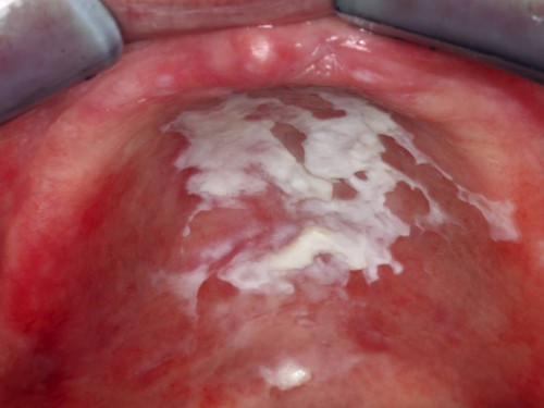 Makroskopie - intraoral 1 präoperativ