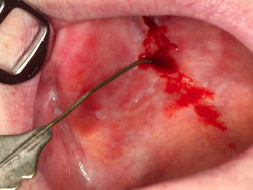 Makroskopie - intraoral 3 präoperativ