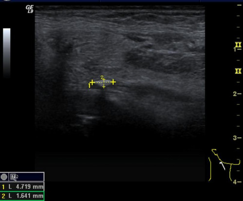 Bildgebung - Sonografie präoperativ