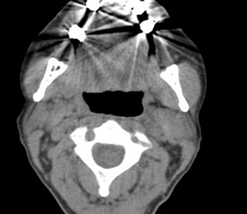 Bildgebung - CT axial präoperativ