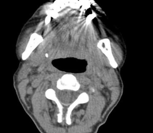 Bildgebung - CT axial präoperativ