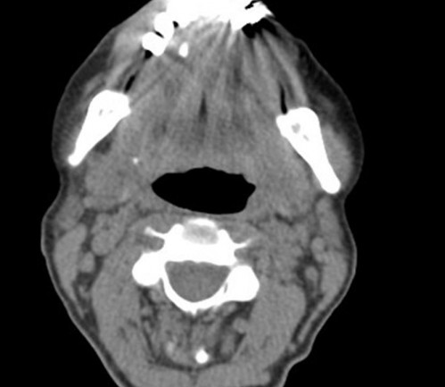 Bildgebung - CT axial präoperativ