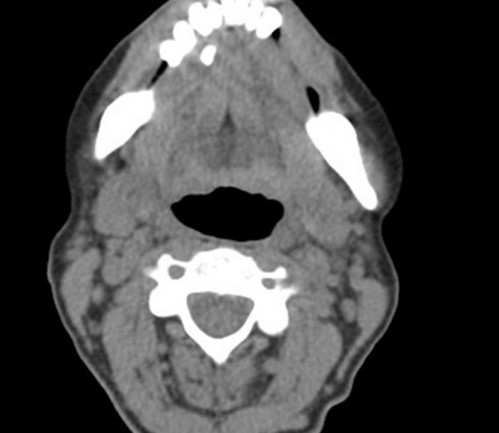 Bildgebung - CT axial präoperativ