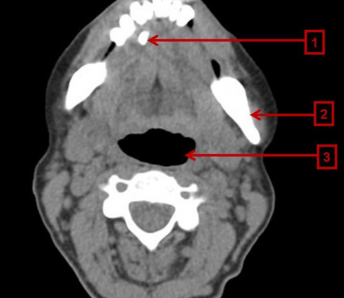 Bildgebung - CT axial präoperativ