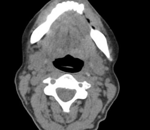 Bildgebung - CT axial präoperativ