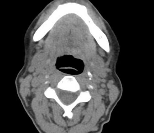 Bildgebung - CT axial präoperativ