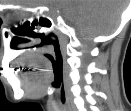 Bildgebung - CT sagittal präoperativ