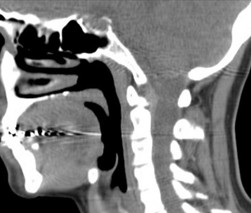 Bildgebung - CT sagittal präoperativ