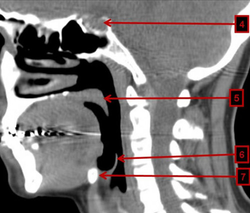 Bildgebung - CT sagittal präoperativ