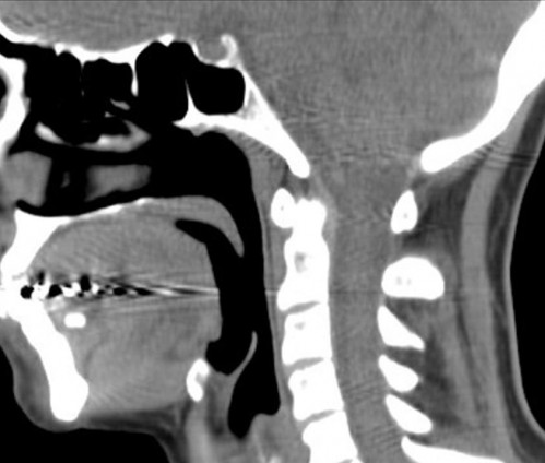 Bildgebung - CT sagittal präoperativ