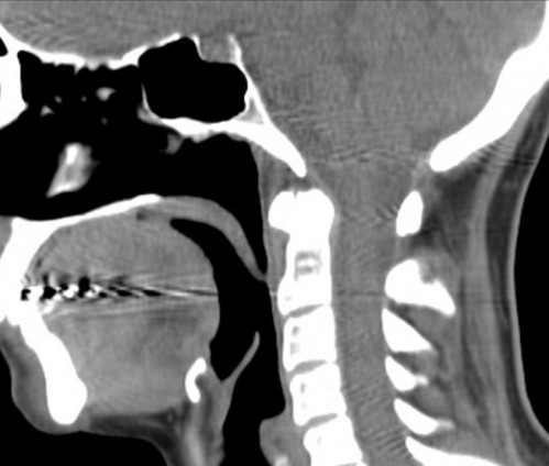 Bildgebung - CT sagittal präoperativ
