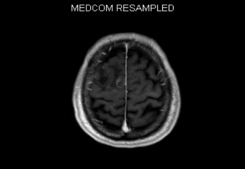 Bildgebung - MRT (T1 + Gadolinium)
