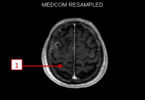Bildgebung - MRT (T1 + Gadolinium) nummeriert