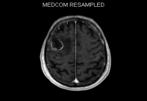 Bildgebung - MRT (T1 + Gadolinium)