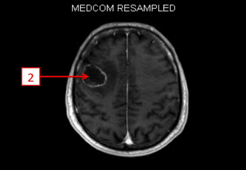 Bildgebung - MRT (T1 + Gadolinium) nummeriert