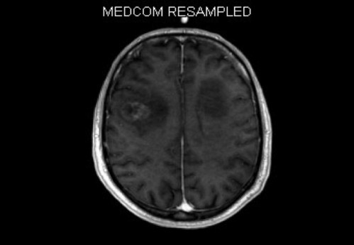 Bildgebung - MRT (T1 + Gadolinium)