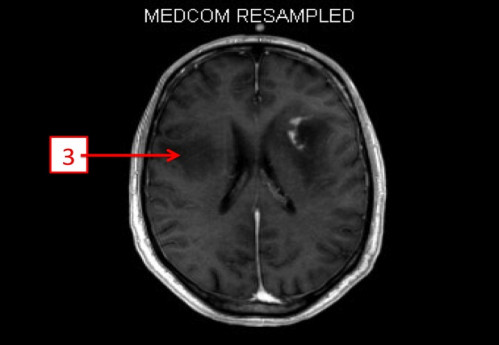 Bildgebung - MRT (T1 + Gadolinium) nummeriert