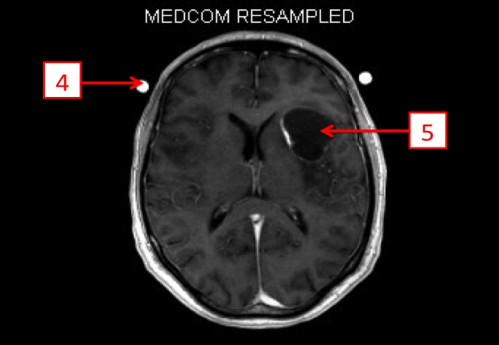 Bildgebung - MRT (T1 + Gadolinium) nummeriert
