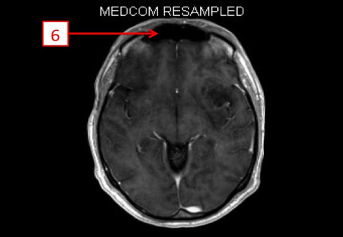 Bildgebung - MRT (T1 + Gadolinium) nummeriert