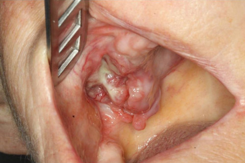Makroskopie - intraoral präoperativ