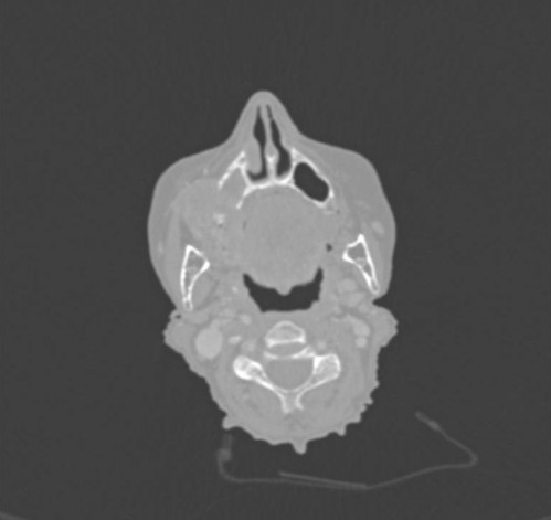 Bildgebung - CT präoperativ