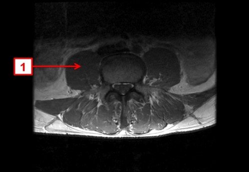 Bildgebung - MRT axial T1-Wichtung mit KM nummeriert