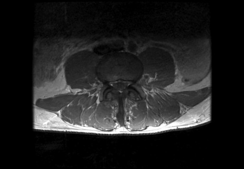 Bildgebung - MRT axial T1-Wichtung mit KM