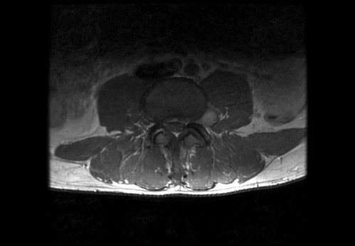 Bildgebung - MRT axial T1-Wichtung mit KM