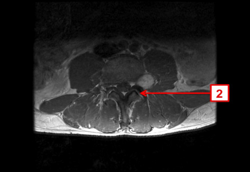 Bildgebung - MRT axial T1-Wichtung mit KM nummeriert