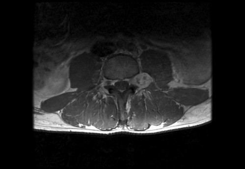 Bildgebung - MRT axial T1-Wichtung mit KM
