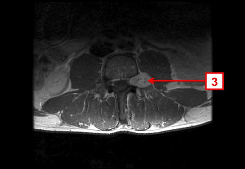 Bildgebung - MRT axial T1-Wichtung mit KM nummeriert