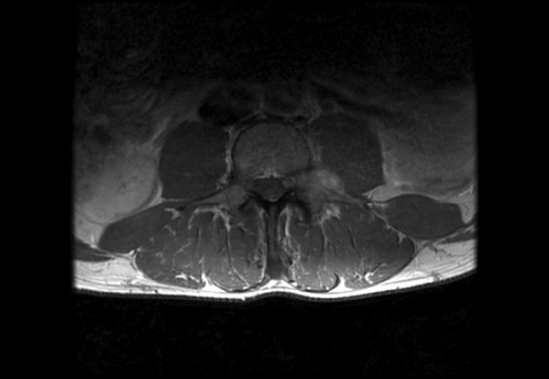 Bildgebung - MRT axial T1-Wichtung mit KM