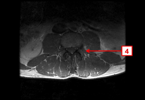 Bildgebung - MRT axial T1-Wichtung mit KM nummeriert