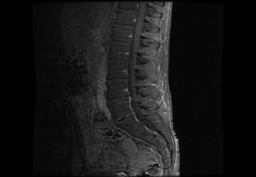 Bildgebung - MRT sagittal T1-Wichtung mit KM