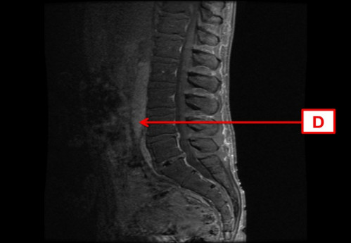 Bildgebung - MRT sagittal T1-Wichtung mit KM nummeriert