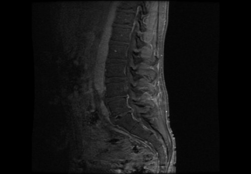 Bildgebung - MRT sagittal T1-Wichtung mit KM