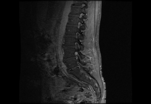 Bildgebung - MRT sagittal T1-Wichtung mit KM
