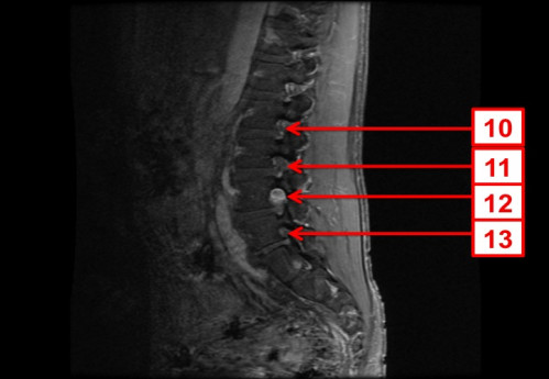 Bildgebung - MRT sagittal T1-Wichtung mit KM nummeriert